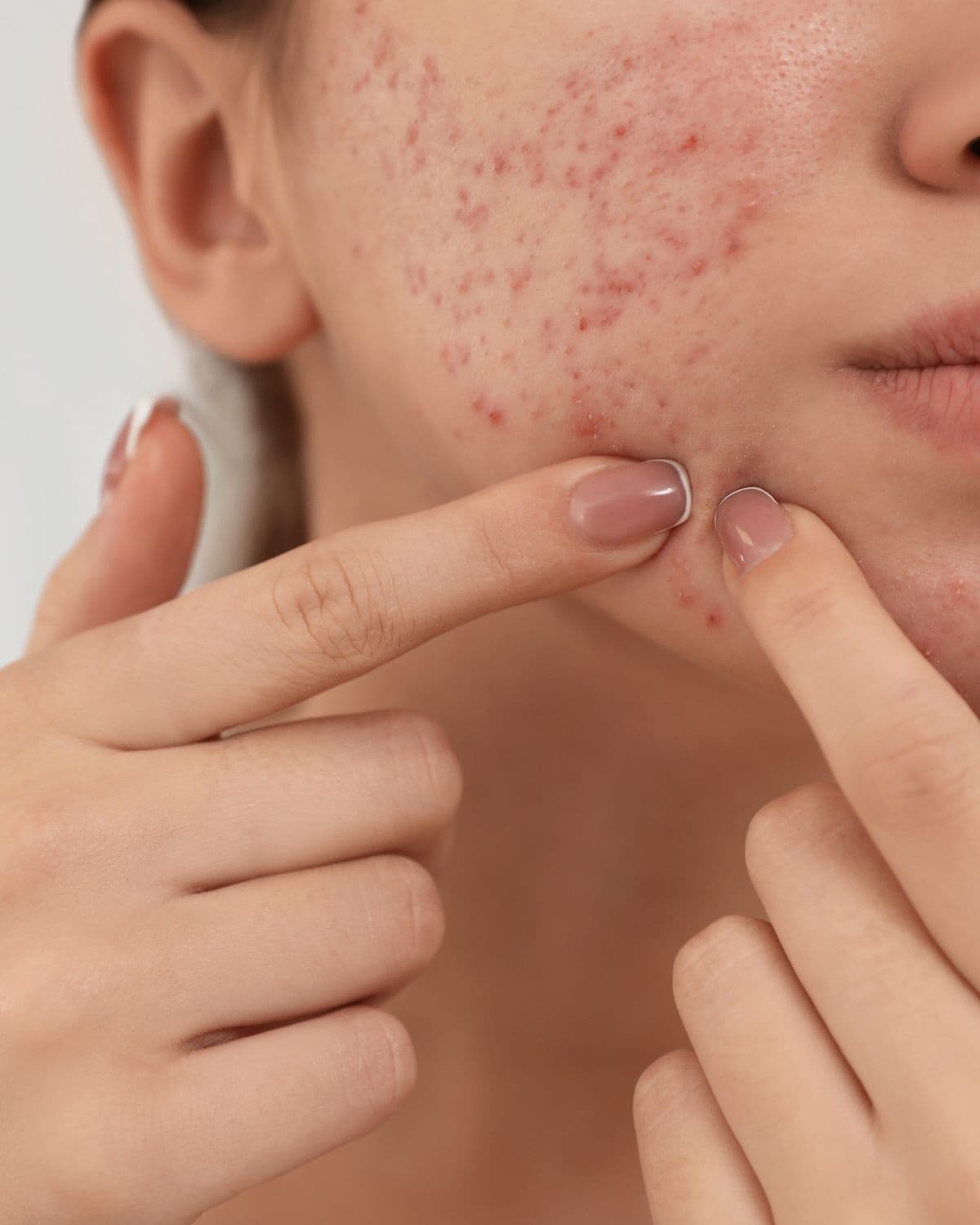 Chất chống oxy hóa trị mụn có tốt không? Vai trò của Flavonoid trong điều trị mụn