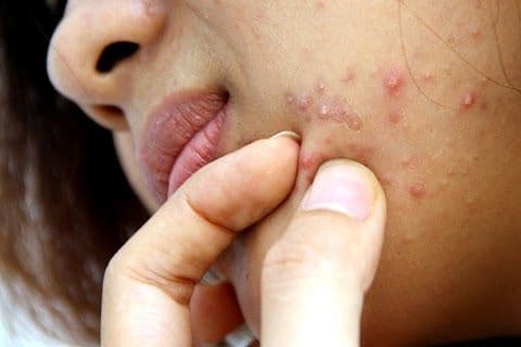 Ăn gì để hết mụn? 10 thực phẩm giúp da sạch mụn từ bên trong